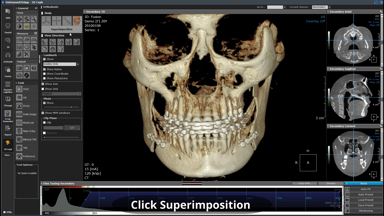 3D-Ceph Module [Superimposition]